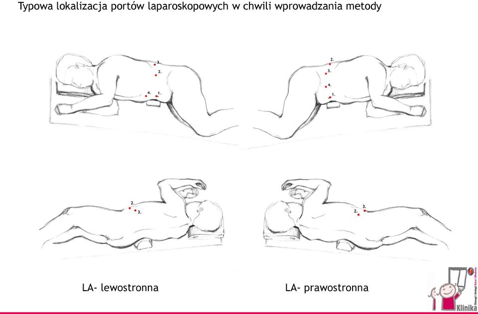 wprowadzania metody LA-