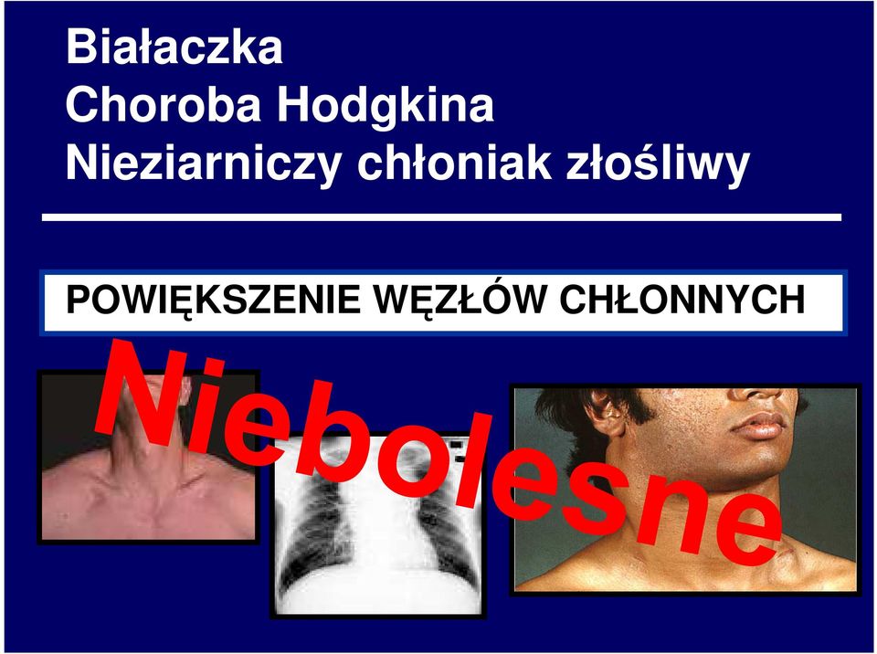 chłoniak złośliwy