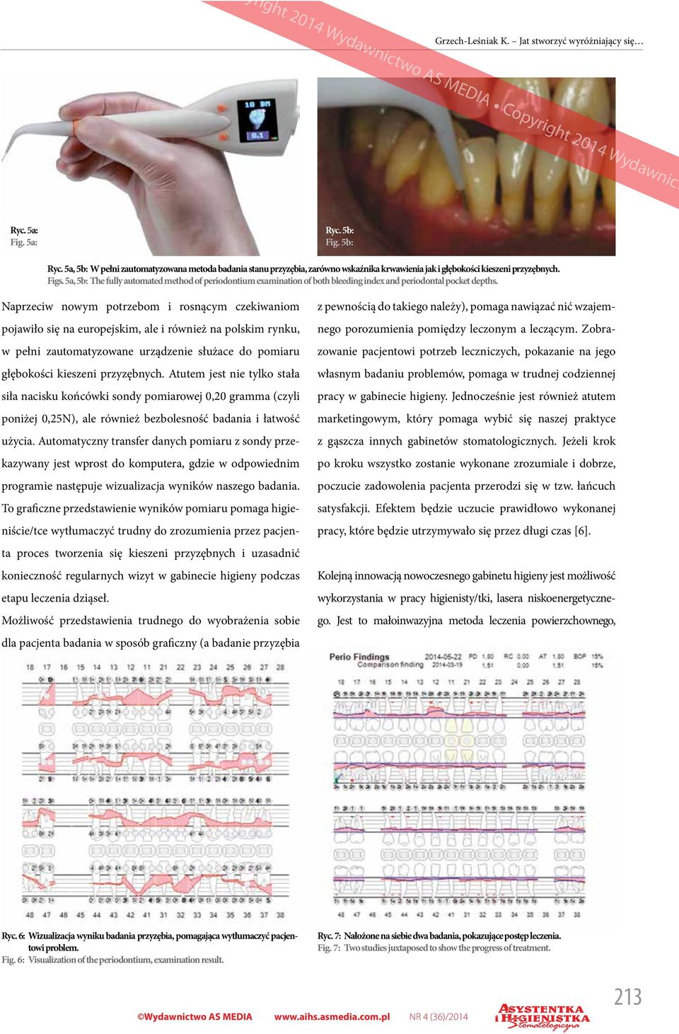 5a, 5b: The fully automated method of periodontium examination of both bleeding index and periodontal pocket depths.