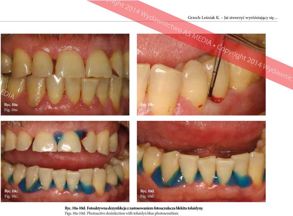10a-10d: Fotoaktywna dezynfekcja z zastosowaniem fotouczulacza błekitu