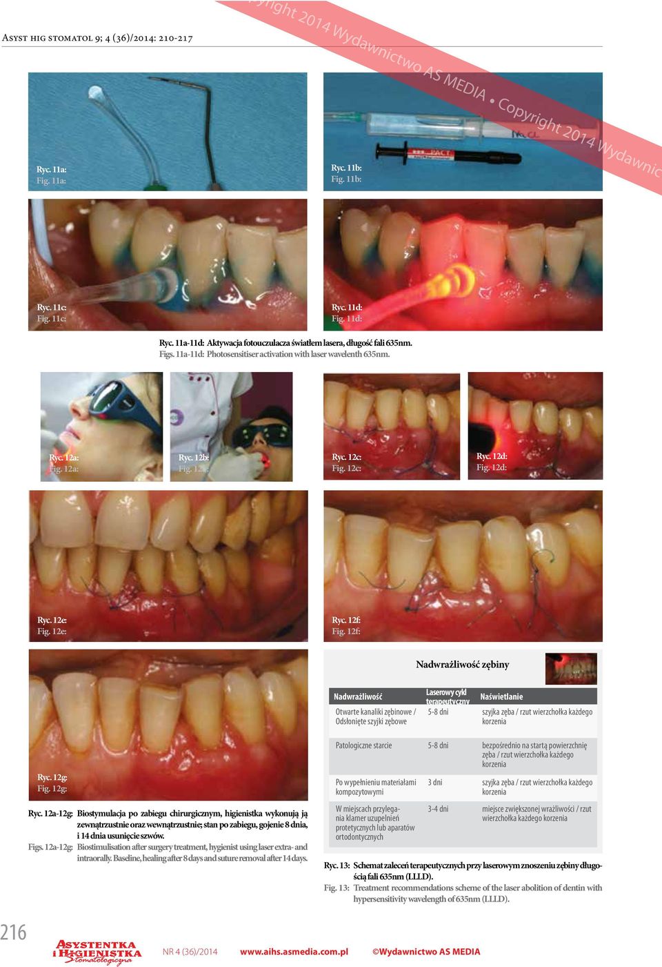 12f: Nadwrażliwość zębiny Nadwrażliwość Otwarte kanaliki zębinowe / Odsłonięte szyjki zębowe Laserowy cykl terapeutyczny Naświetlanie 5-8 dni szyjka zęba / rzut wierzchołka każdego korzenia Ryc.