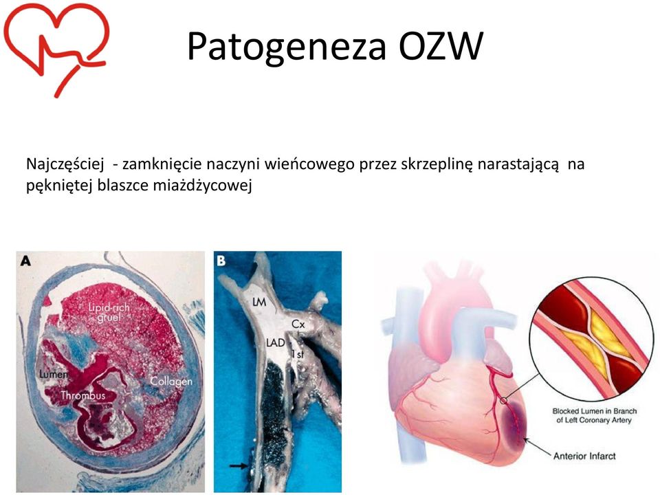 przez skrzeplinę narastającą