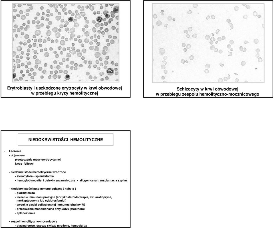 ) - plazmafereza - leczenie immunosupresyjne (kortykosteroidoterapia, ew.