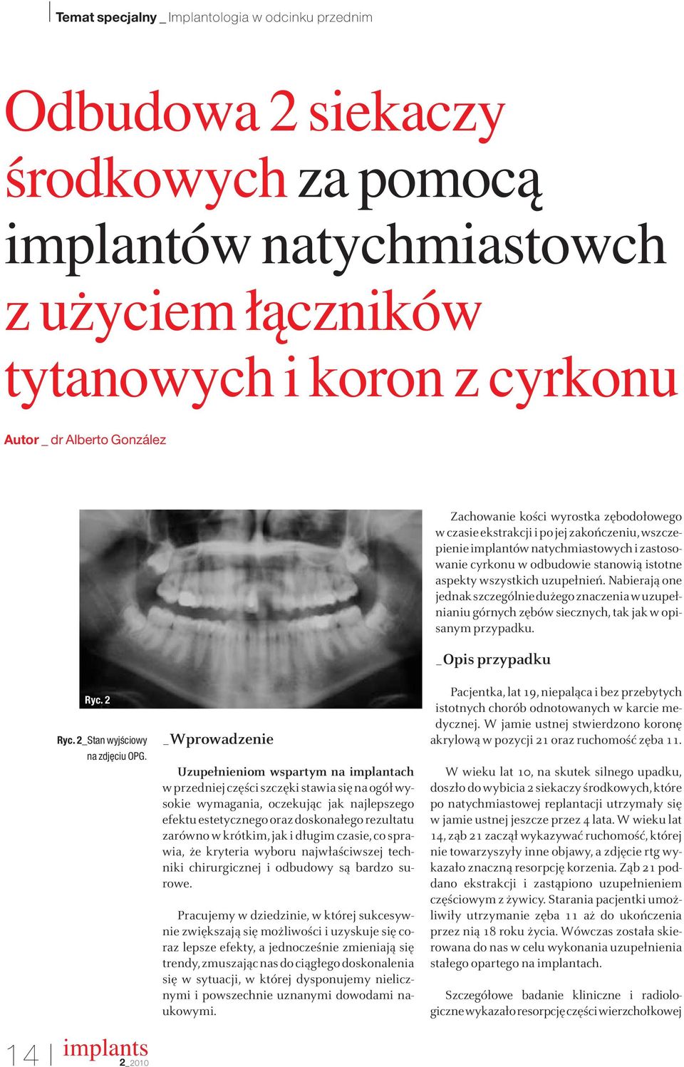 uzupełnień. Nabierają one jednak szczególnie dużego znaczenia w uzupełnianiu górnych zębów siecznych, tak jak w opisanym przypadku. _Opis przypadku Ryc. 2 Ryc. 2_Stan wyjêciowy na zdj ciu OPG.