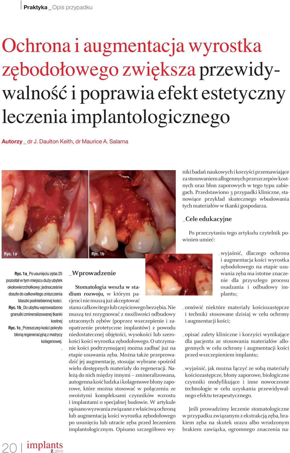 Nie muszą też rezygnować z możliwości odbudowy utraconych zębów (poprzez wszczepienie i zaopatrzenie protetyczne implantów) z powodu niedostatecznej objętości, wysokości lub szerokości kości wyrostka