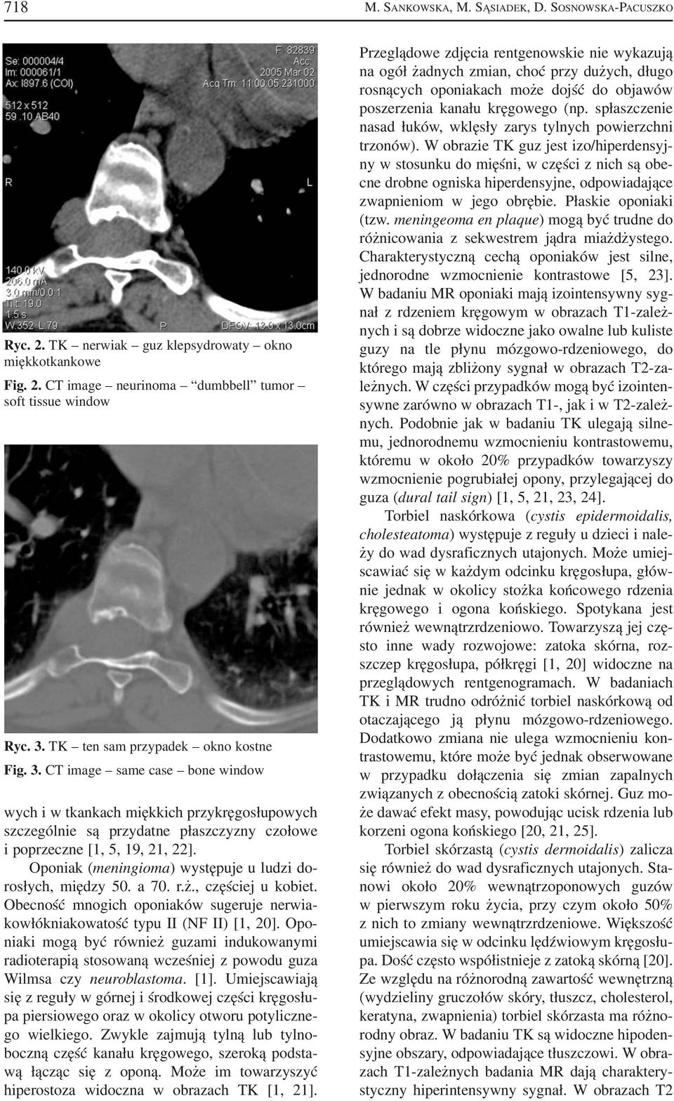 Oponiak (meningioma) występuje u ludzi do rosłych, między 50. a 70. r.ż., częściej u kobiet. Obecność mnogich oponiaków sugeruje nerwia kowłókniakowatość typu II (NF II) [1, 20].