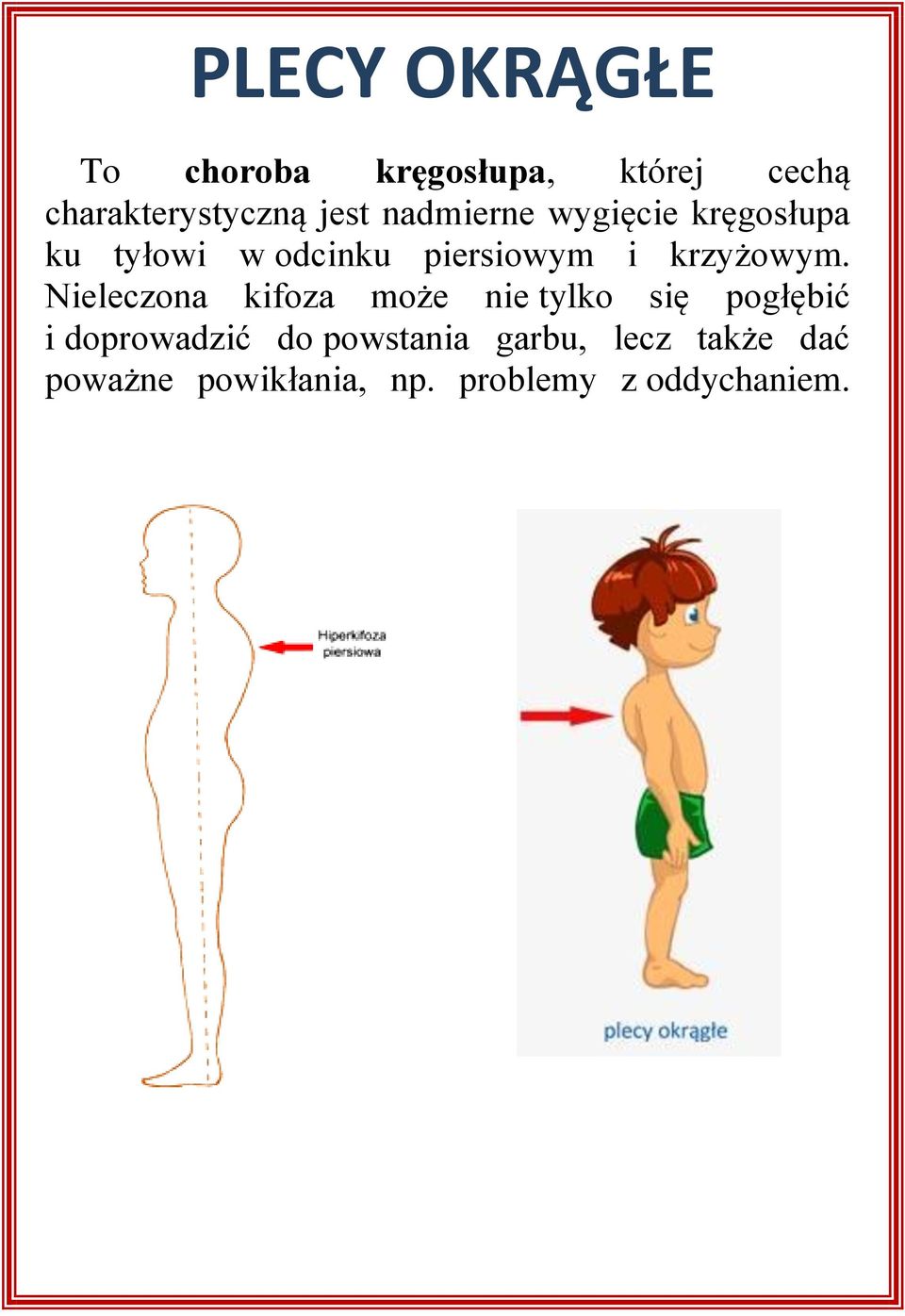 Nieleczona kifoza może nie tylko się pogłębić i doprowadzić do powstania