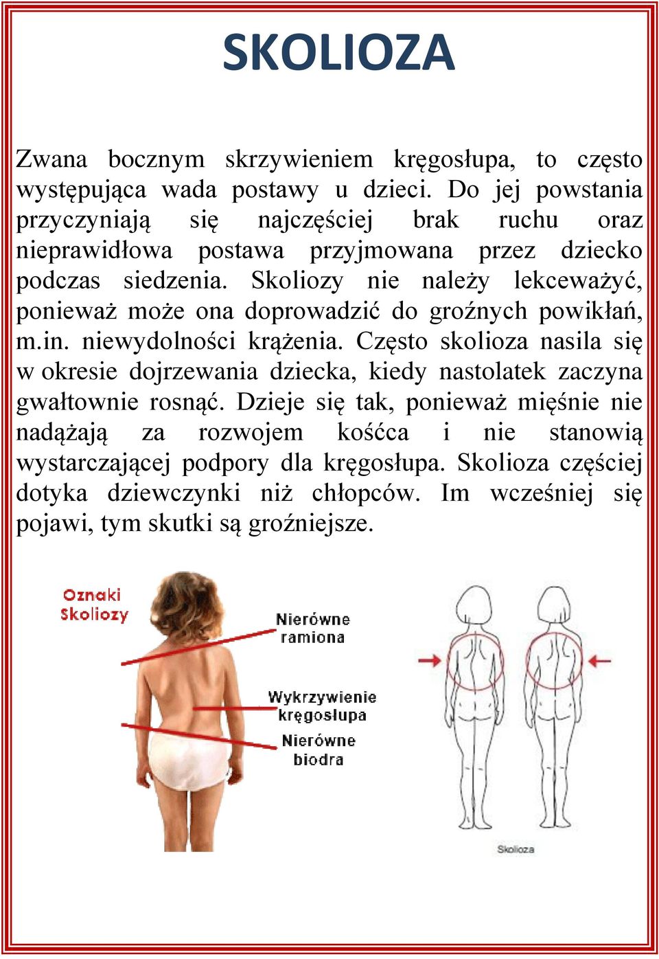 Skoliozy nie należy lekceważyć, ponieważ może ona doprowadzić do groźnych powikłań, m.in. niewydolności krążenia.