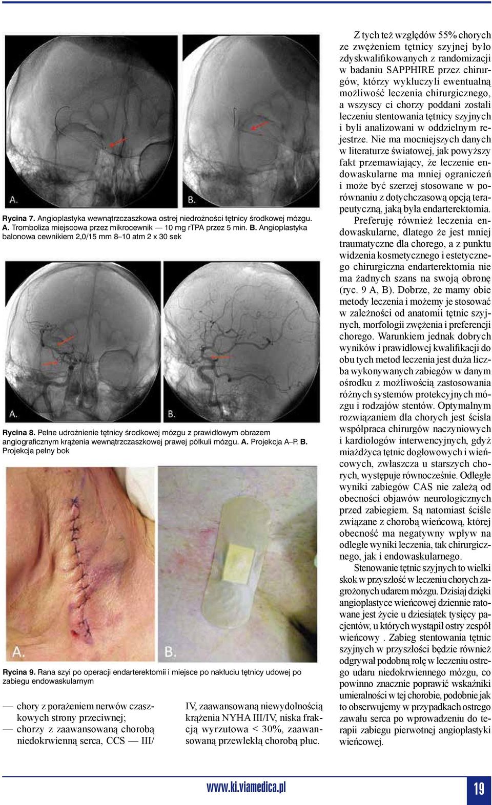 Pełne udrożnienie tętnicy środkowej mózgu z prawidłowym obrazem angiograficznym krążenia wewnątrzczaszkowej prawej półkuli mózgu. A. Projekcja A P. B. Projekcja pełny bok Rycina 9.