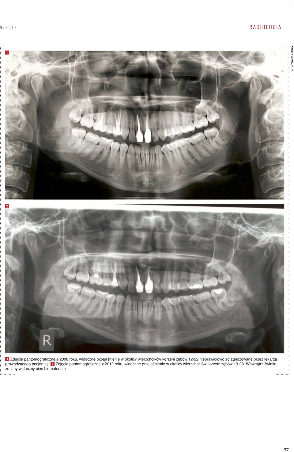 wierzchołków korzeni zębów 12-22 nieprawidłowo zdiagnozowane przez lekarza prowadzącego