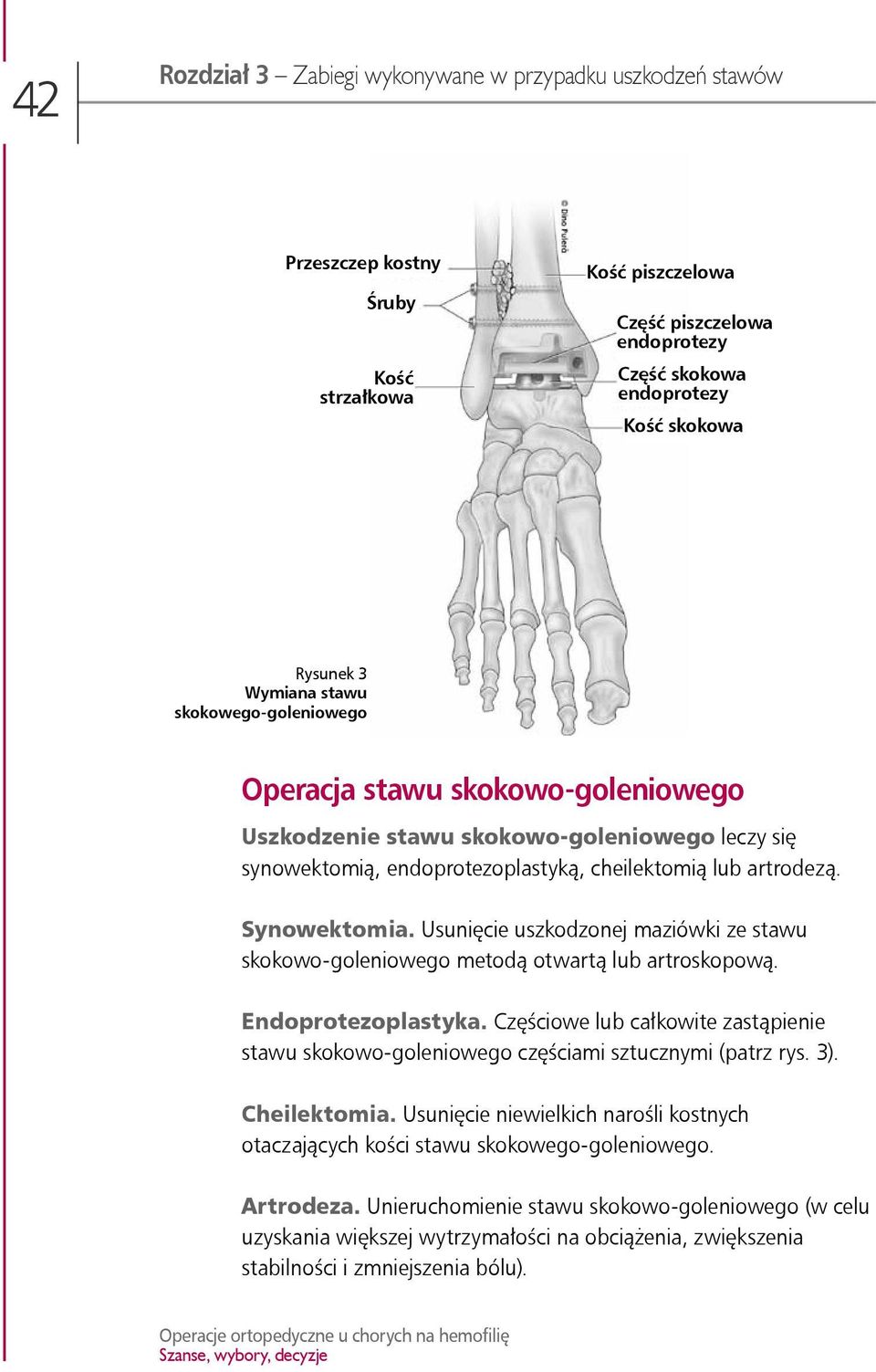 Usunięcie uszkodzonej maziówki ze stawu skokowo-goleniowego metodą otwartą lub artroskopową. Endoprotezoplastyka.