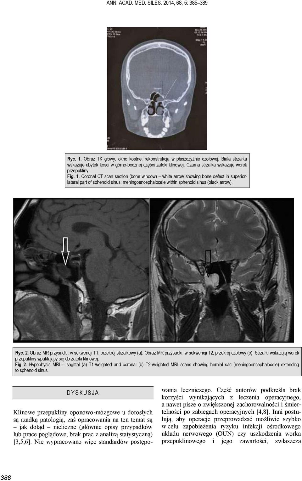 Coronal CT scan section (bone window) white arrow showing bone defect in superiorlateral part of sphenoid sinus; meningoencephalocele within sphenoid sinus (black arrow). Ryc. 2.