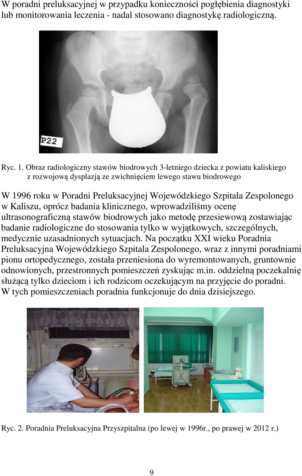 Zespolonego w Kaliszu, oprócz badania klinicznego, wprowadziliśmy ocenę ultrasonograficzną stawów biodrowych jako metodę przesiewową zostawiając badanie radiologiczne do stosowania tylko w