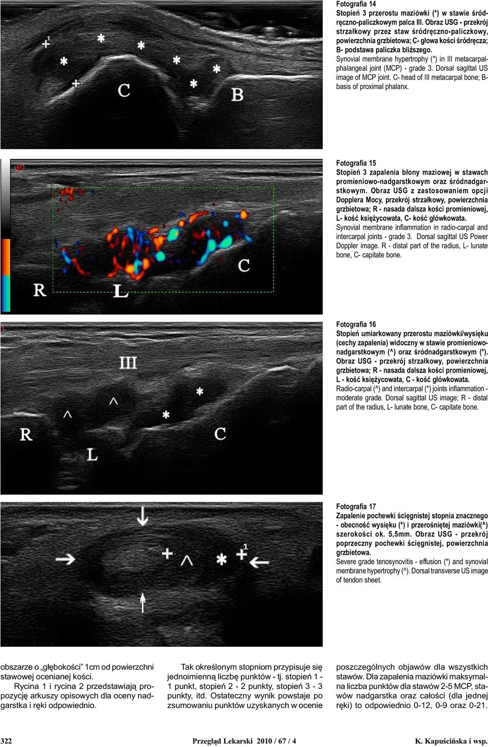 Synovial membrane hypertrophy (*) in III metacarpalphalangeal joint (MCP) - grade 3. Dorsal sagittal US image of MCP joint. C- head of III metacarpal bone; B- basis of proximal phalanx.