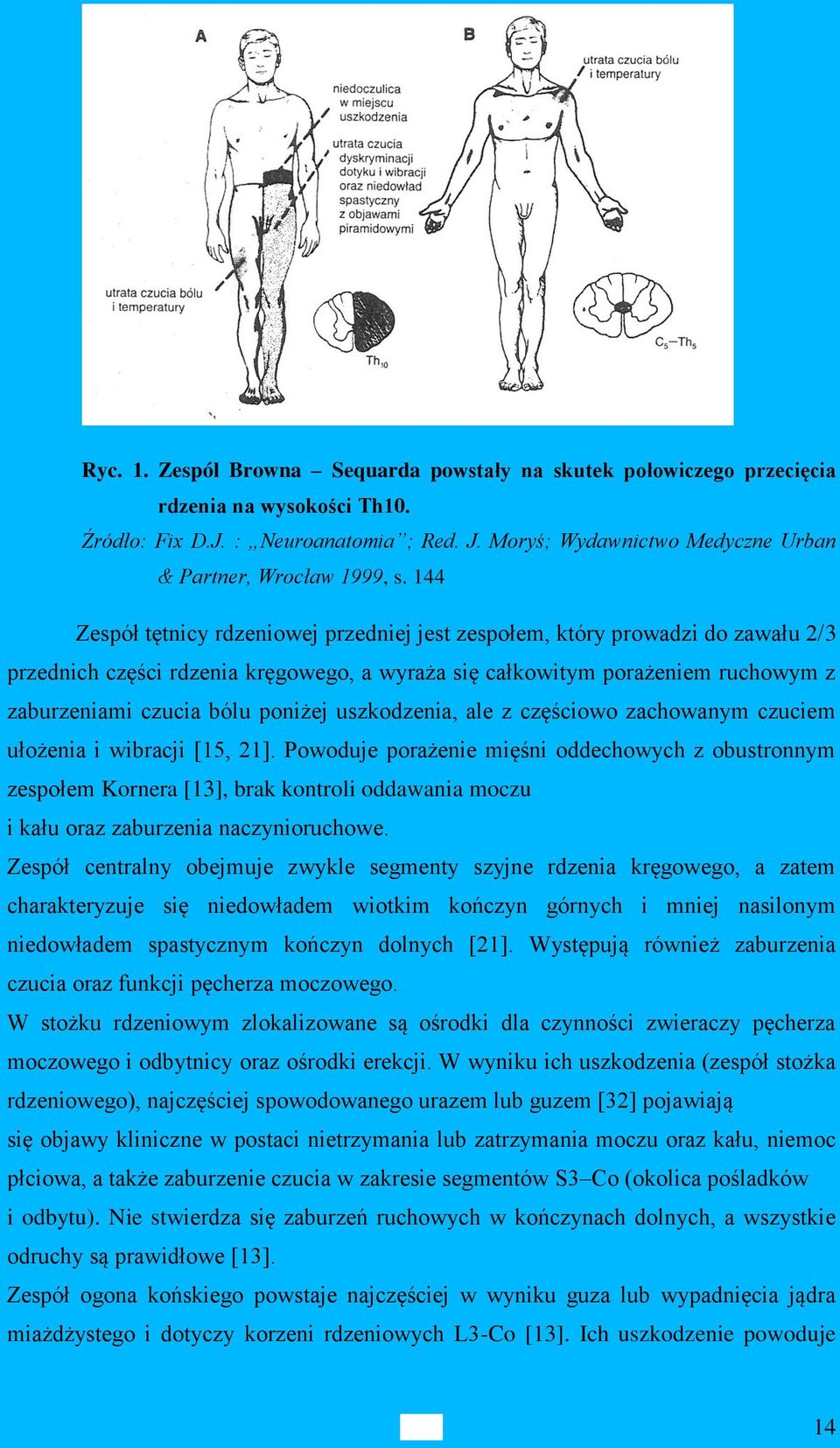 144 Zespół tętnicy rdzeniowej przedniej jest zespołem, który prowadzi do zawału 2/3 przednich części rdzenia kręgowego, a wyraża się całkowitym porażeniem ruchowym z zaburzeniami czucia bólu poniżej