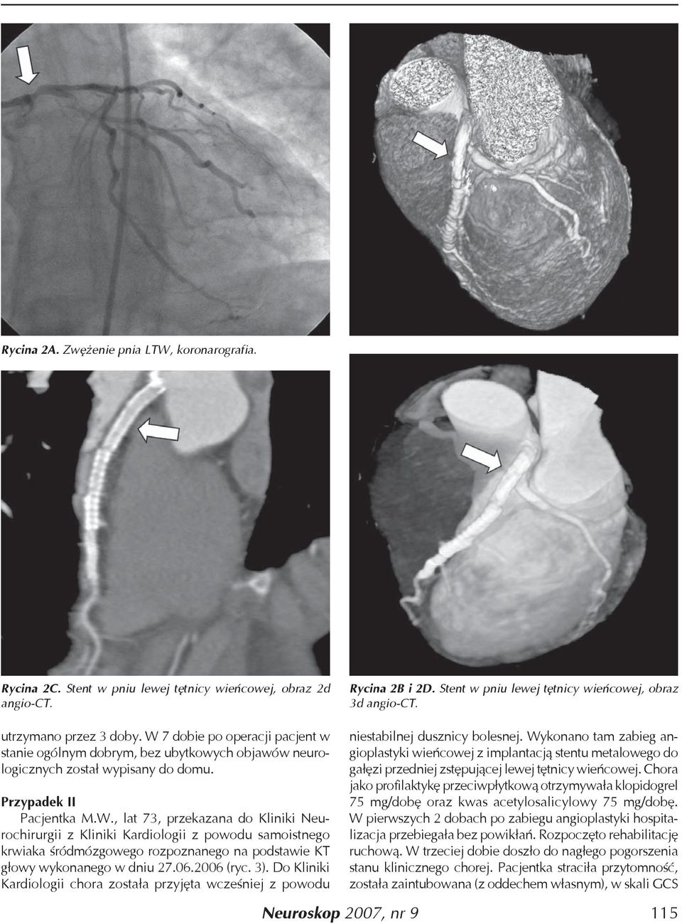 06.2006 (ryc. 3). Do Kliniki Kardiologii chora została przyjęta wcześniej z powodu Rycina 2B i 2D. Stent w pniu lewej tętnicy wieńcowej, obraz 3d angio-ct. niestabilnej dusznicy bolesnej.