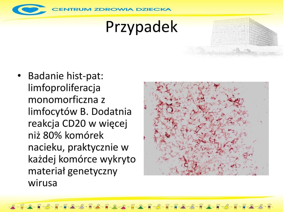 Dodatnia reakcja CD20 w więcej niż 80% komórek