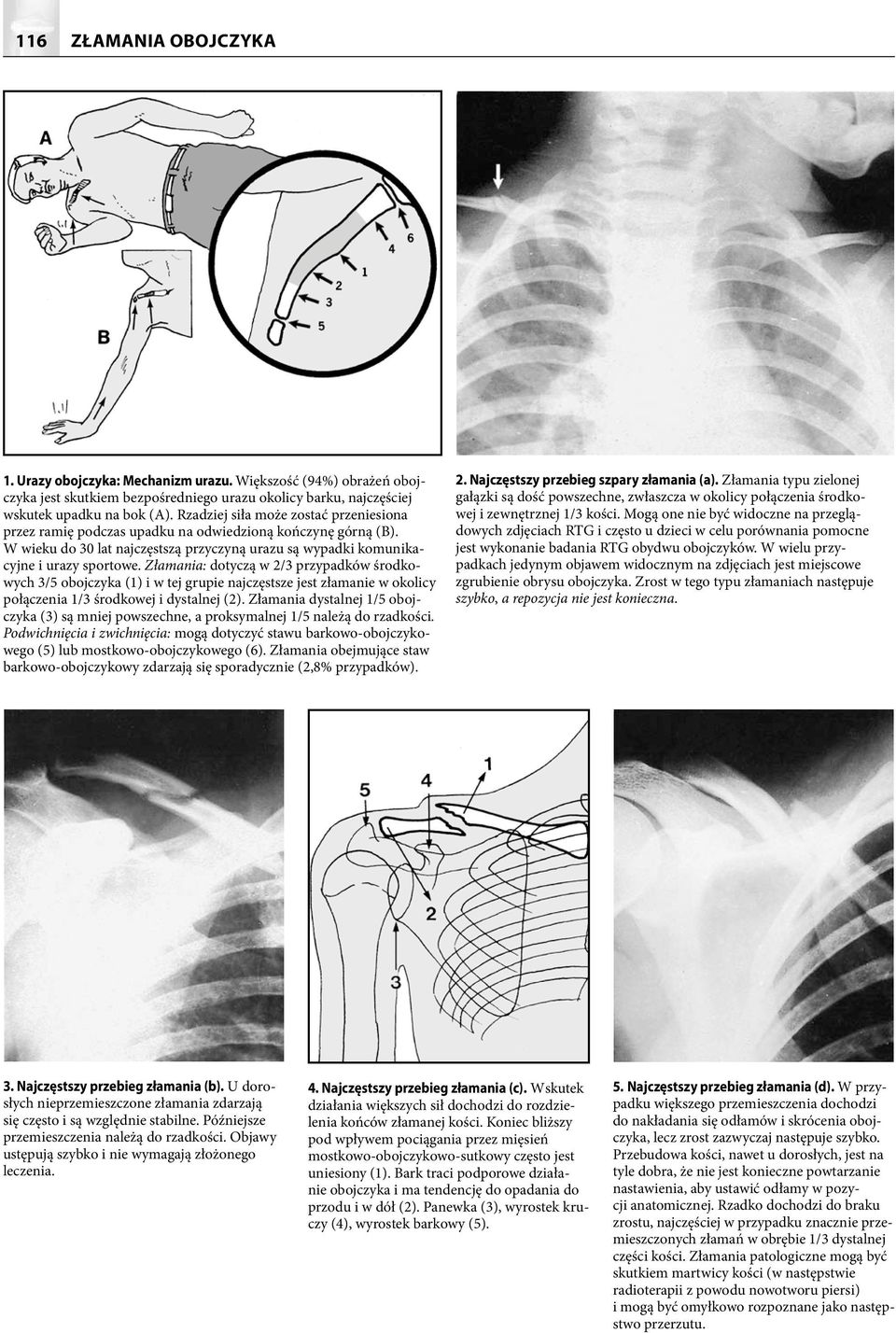 Złamania: dotyczą w 2/3 przypadków środkowych 3/5 obojczyka (1) i w tej grupie najczęstsze jest złamanie w okolicy połączenia 1/3 środkowej i dystalnej (2).