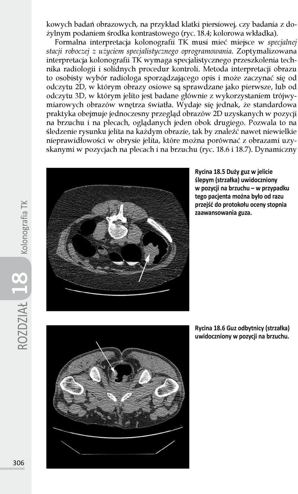 Zoptymalizowana interpretacja kolonografii TK wymaga specjalistycznego przeszkolenia technika radiologii i solidnych procedur kontroli.