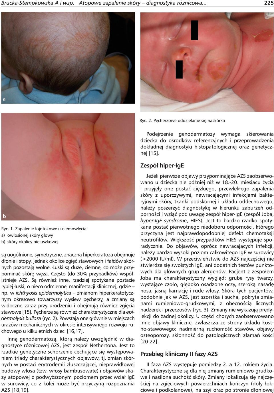 Pęcherzowe oddzielanie się naskórka Podejrzenie genodermatozy wymaga skierowania dziecka do ośrodków referencyjnych i przeprowadzenia dokładnej diagnostyki histopatologicznej oraz genetycznej [15].