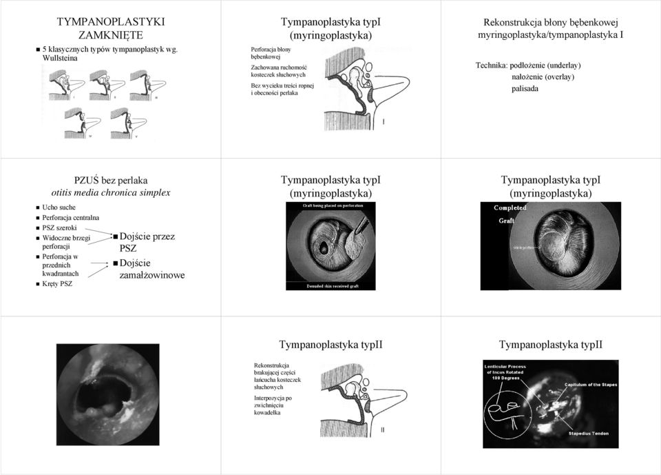 bębenkowej myringoplastyka/tympanoplastyka I Technika: podłożenie (underlay) nałożenie (overlay) palisada PZUŚ bez perlaka otitis media chronica simplex Tympanoplastyka typi (myringoplastyka)