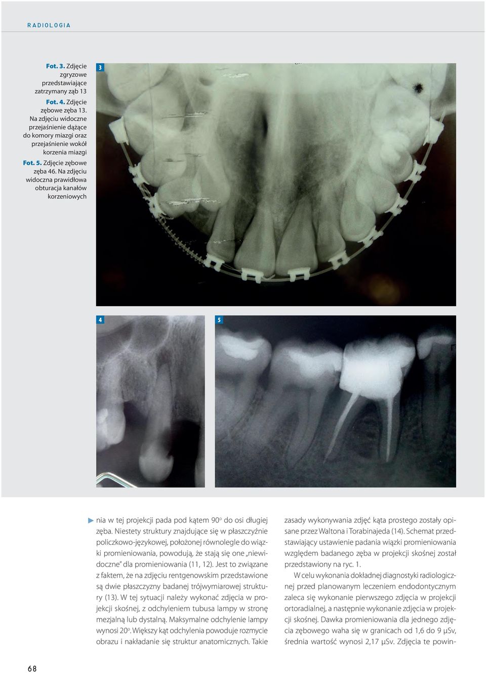 Na zdjęciu widoczna prawidłowa obturacja kanałów korzeniowych 3 4 5 nia w tej projekcji pada pod kątem 90 o do osi długiej zęba.