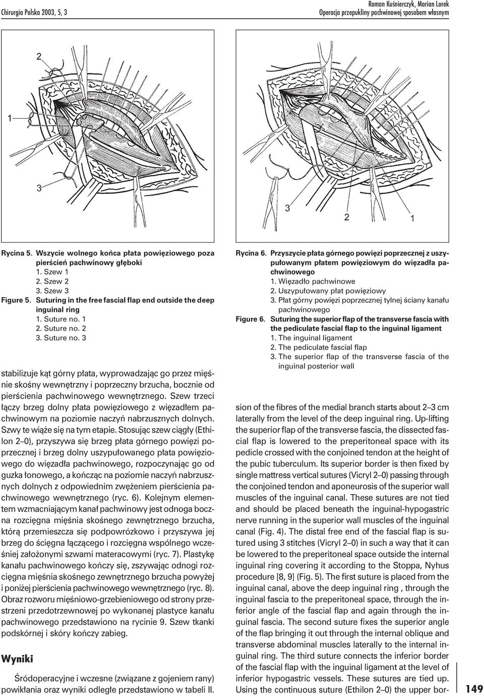 1 2. Suture no. 2 3. Suture no. 3 stabilizuje kąt górny płata, wyprowadzając go przez mięśnie skośny wewnętrzny i poprzeczny brzucha, bocznie od pierścienia pachwinowego wewnętrznego.