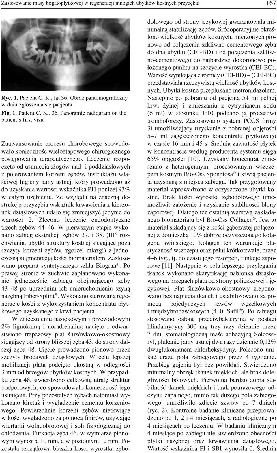 Leczenie rozpo częto od usunięcia złogów nad i poddziąsłowych z polerowaniem korzeni zębów, instruktażu wła ściwej higieny jamy ustnej, który prowadzono aż do uzyskania wartości wskaźnika PI1 poniżej