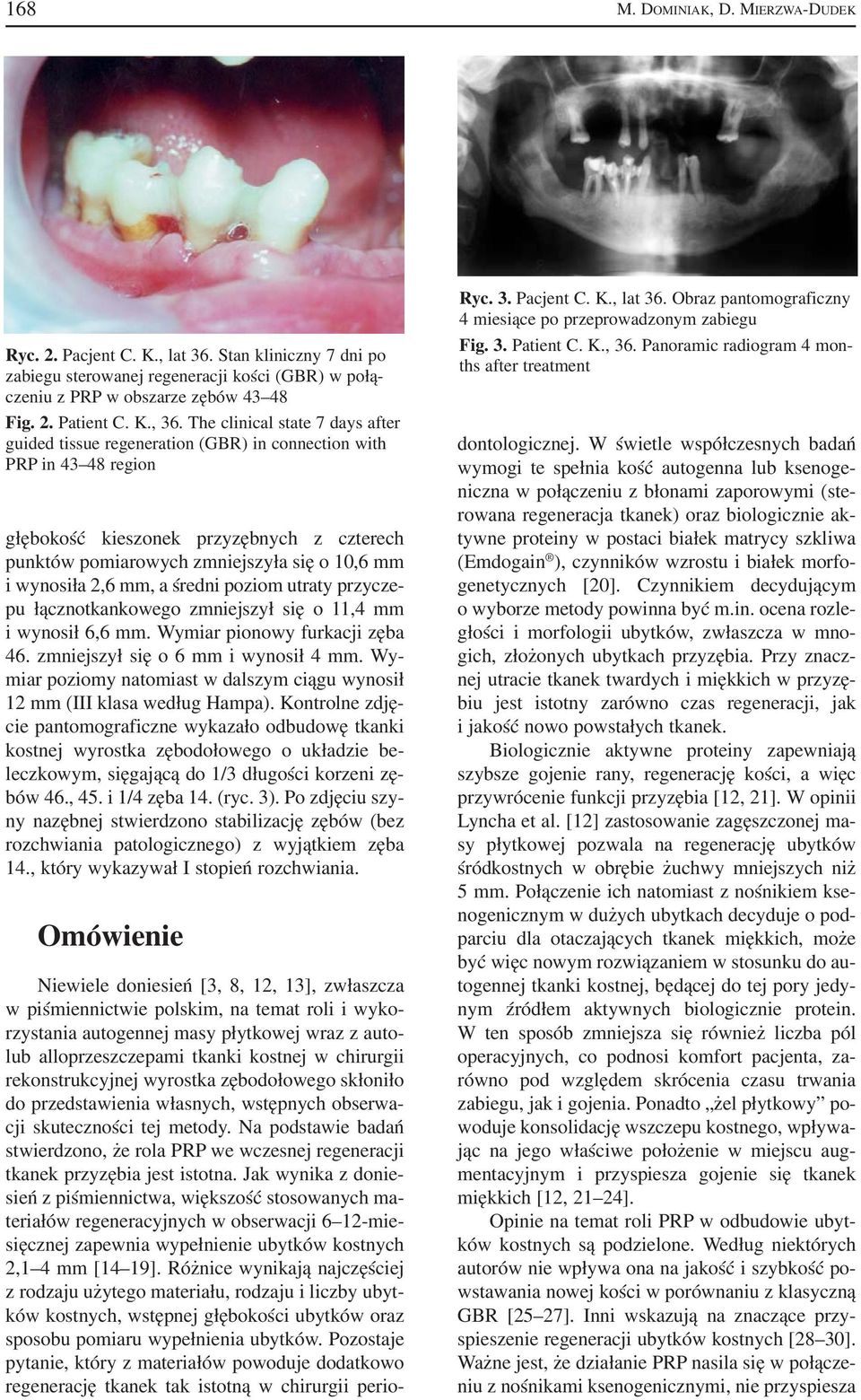 wynosiła 2,6 mm, a średni poziom utraty przycze pu łącznotkankowego zmniejszył się o 11,4 mm i wynosił 6,6 mm. Wymiar pionowy furkacji zęba 46. zmniejszył się o 6 mm i wynosił 4 mm.