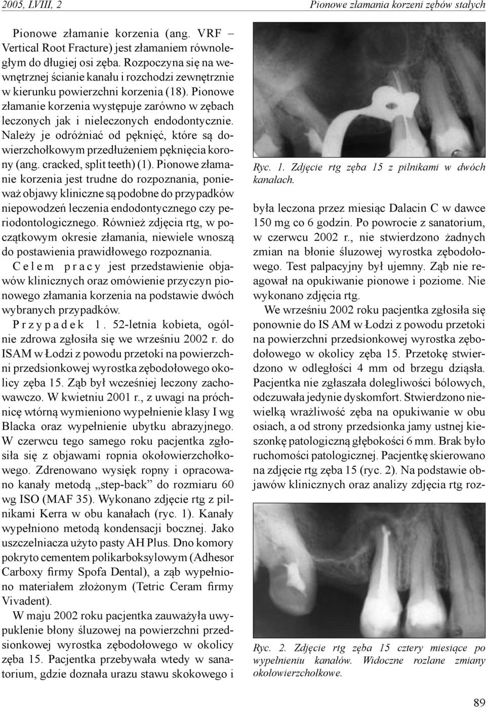 Pionowe złamanie korzenia występuje zarówno w zębach leczonych jak i nieleczonych endodontycznie. Należy je odróżniać od pęknięć, które są dowierzchołkowym przedłużeniem pęknięcia korony (ang.