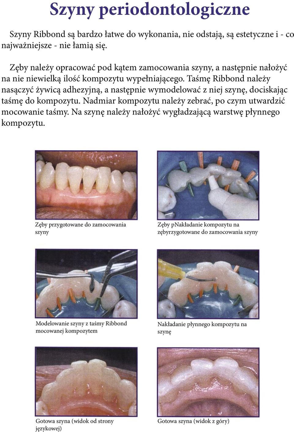 Taśmę Ribbond należy nasączyć żywicą adhezyjną, a następnie wymodelować z niej szynę, dociskając taśmę do kompozytu. Nadmiar kompozytu należy zebrać, po czym utwardzić mocowanie taśmy.