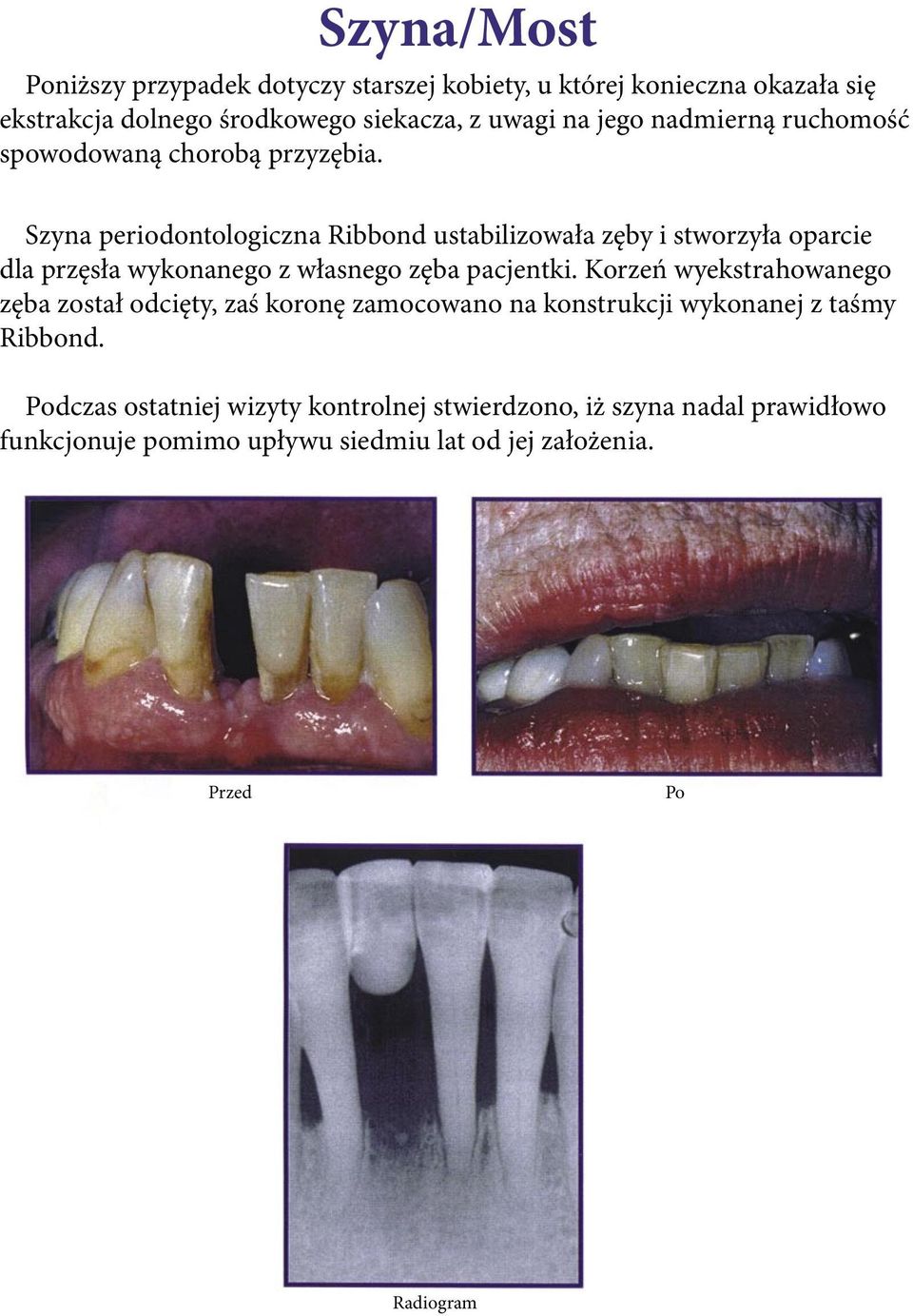 Szyna periodontologiczna Ribbond ustabilizowała zęby i stworzyła oparcie dla przęsła wykonanego z własnego zęba pacjentki.