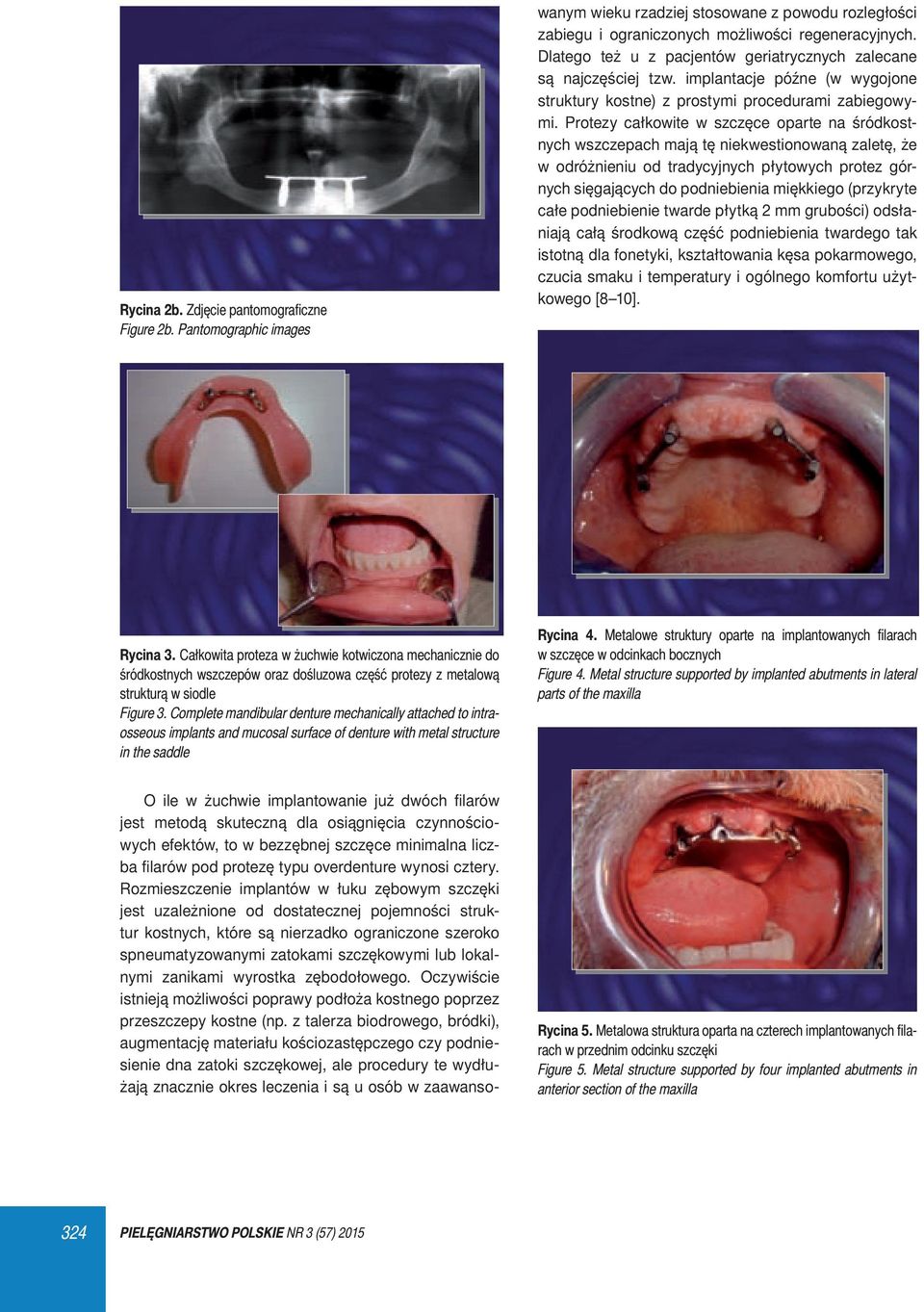 overdenture wynosi cztery.