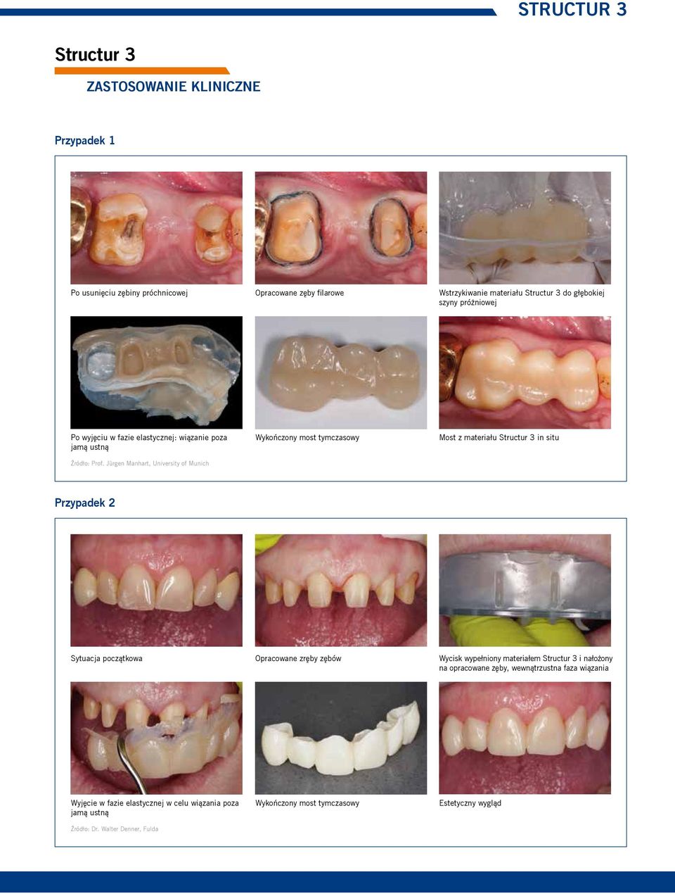 Jürgen Manhart, University of Munich Wykończony most tymczasowy Most z materiału in situ Przypadek 2 Sytuacja początkowa Opracowane zręby zębów