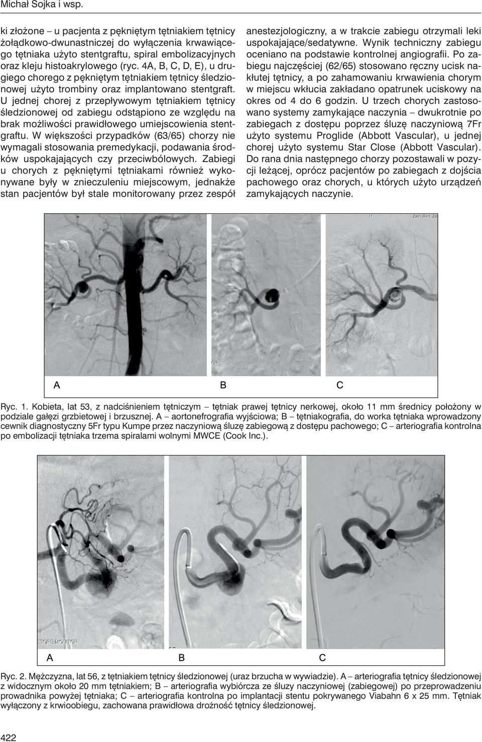 4A, B, C, D, E), u drugiego chorego z pękniętym tętniakiem tętnicy śledzionowej użyto trombiny oraz implantowano stentgraft.