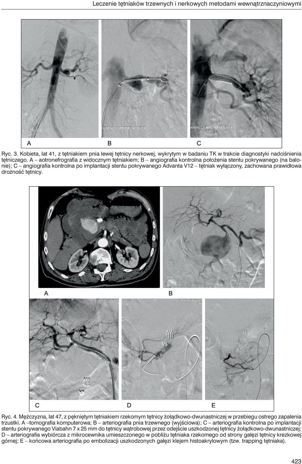 A aotronefrografia z widocznym tętniakiem; B angiografia kontrolna położenia stentu pokrywanego (na balonie); C angiografia kontrolna po implantacji stentu pokrywanego Advanta V12 tętniak wyłączony,