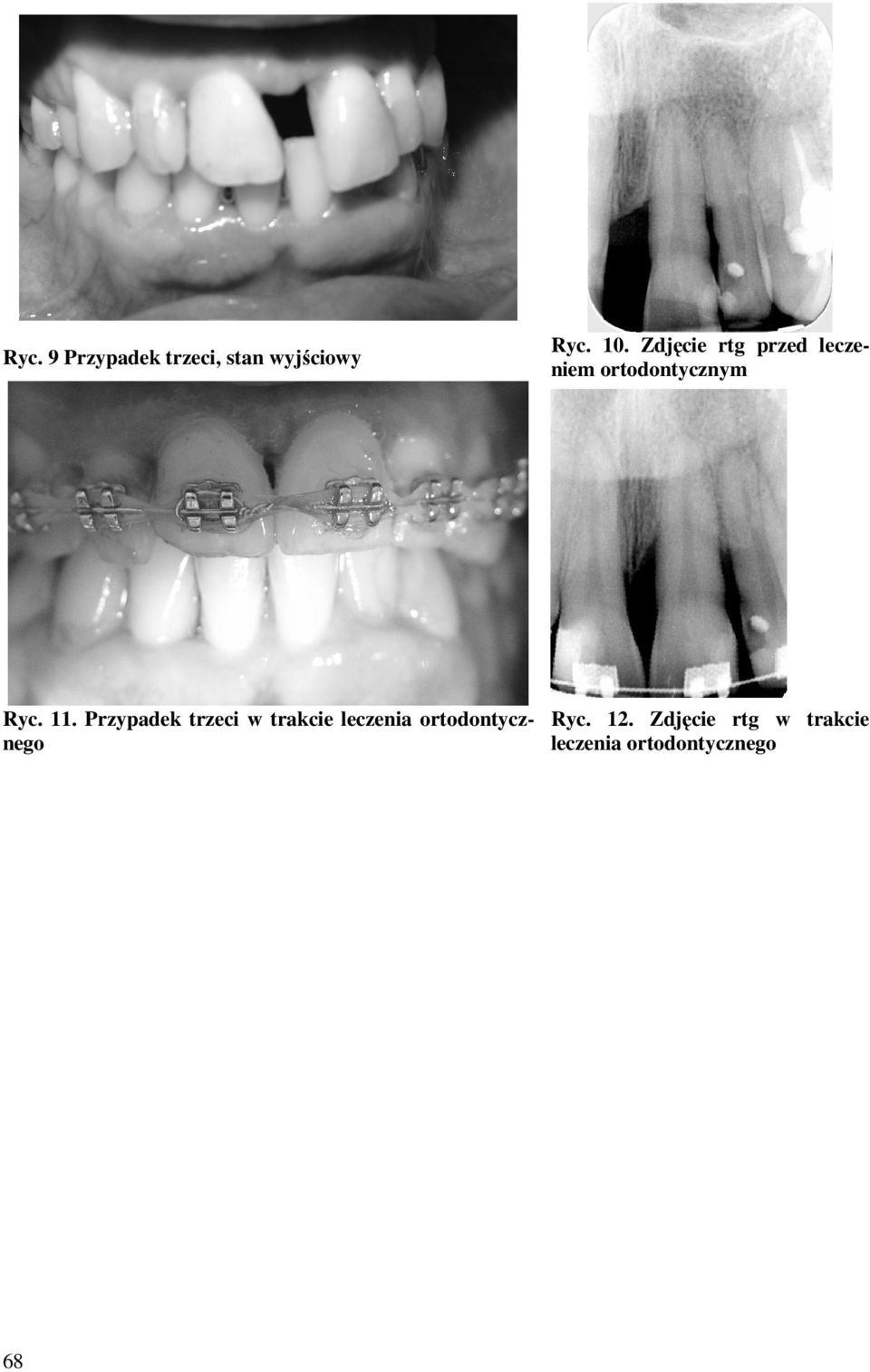 Przypadek trzeci w trakcie leczenia ortodontycznego
