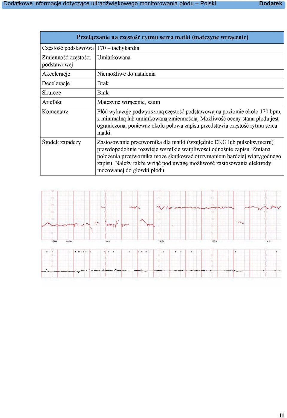 poziomie około 170 bpm, z minimalną lub umiarkowaną zmiennością. Możliwość oceny stanu płodu jest ograniczona, ponieważ około połowa zapisu przedstawia częstość rytmu serca matki.