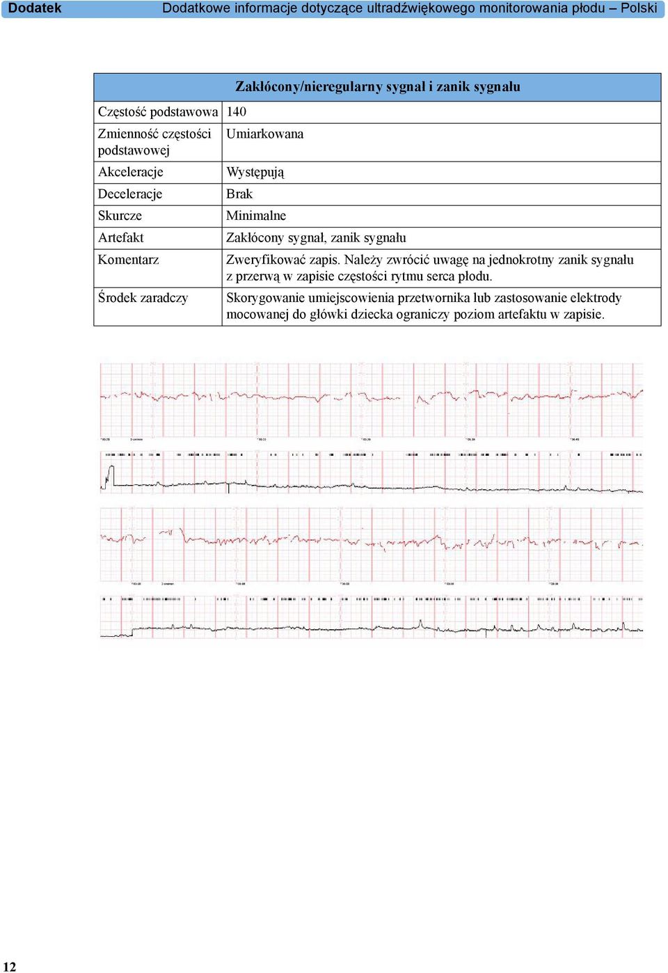 zanik sygnału Komentarz Zweryfikować zapis. Należy zwrócić uwagę na jednokrotny zanik sygnału z przerwą w zapisie częstości rytmu serca płodu.