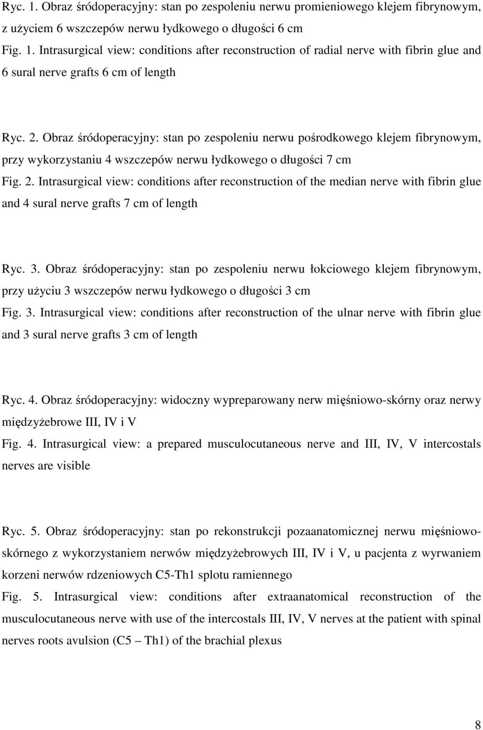 Intrasurgical view: conditions after reconstruction of the median nerve with fibrin glue and 4 sural nerve grafts 7 cm of length Ryc. 3.