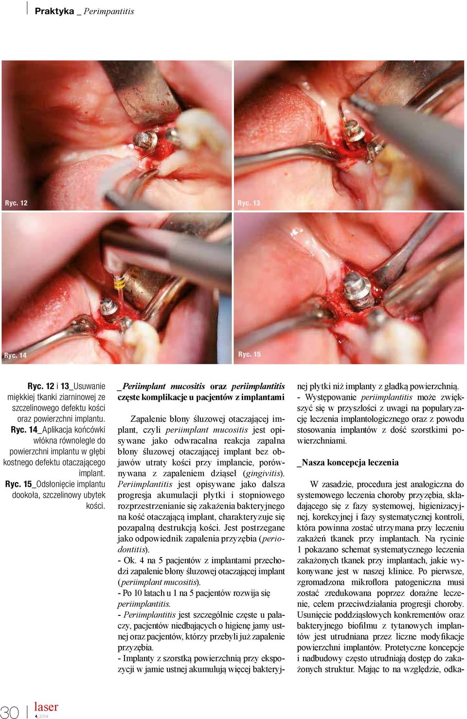 _Periimplant mucositis oraz periimplantitis częste komplikacje u pacjentów z implantami Zapalenie błony śluzowej otaczającej implant, czyli periimplant mucositis jest opisywane jako odwracalna