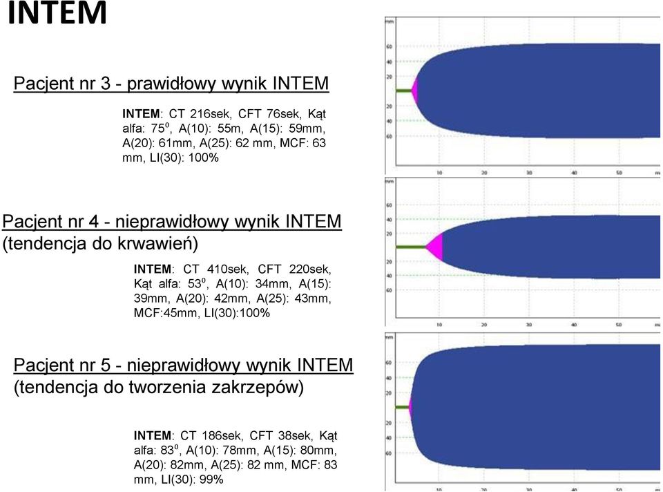 53⁰, A(10): 34mm, A(15): 39mm, A(20): 42mm, A(25): 43mm, MCF:45mm, LI(30):100% Pacjent nr 5 - nieprawidłowy wynik INTEM (tendencja do