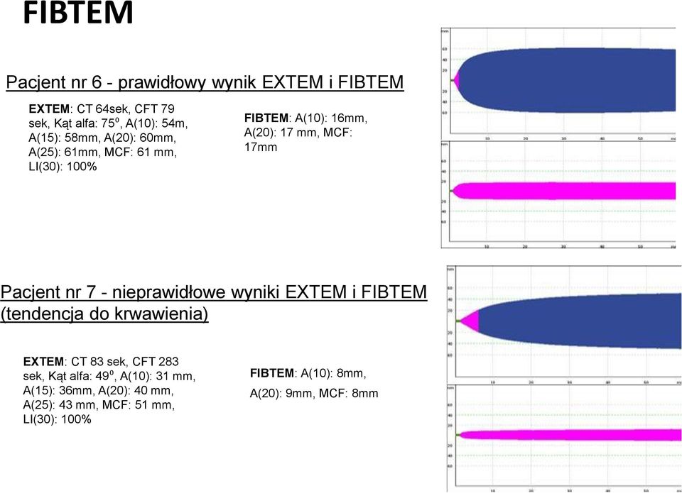 Pacjent nr 7 - nieprawidłowe wyniki EXTEM i FIBTEM (tendencja do krwawienia) EXTEM: CT 83 sek, CFT 283 sek, Kąt