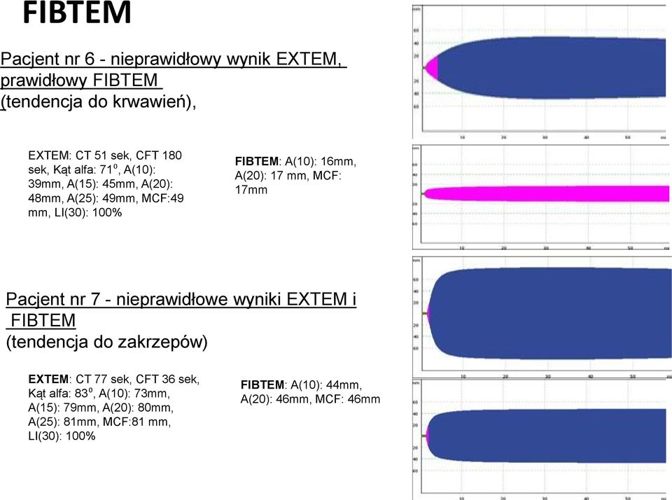 mm, MCF: 17mm Pacjent nr 7 - nieprawidłowe wyniki EXTEM i FIBTEM (tendencja do zakrzepów) EXTEM: CT 77 sek, CFT 36 sek, Kąt