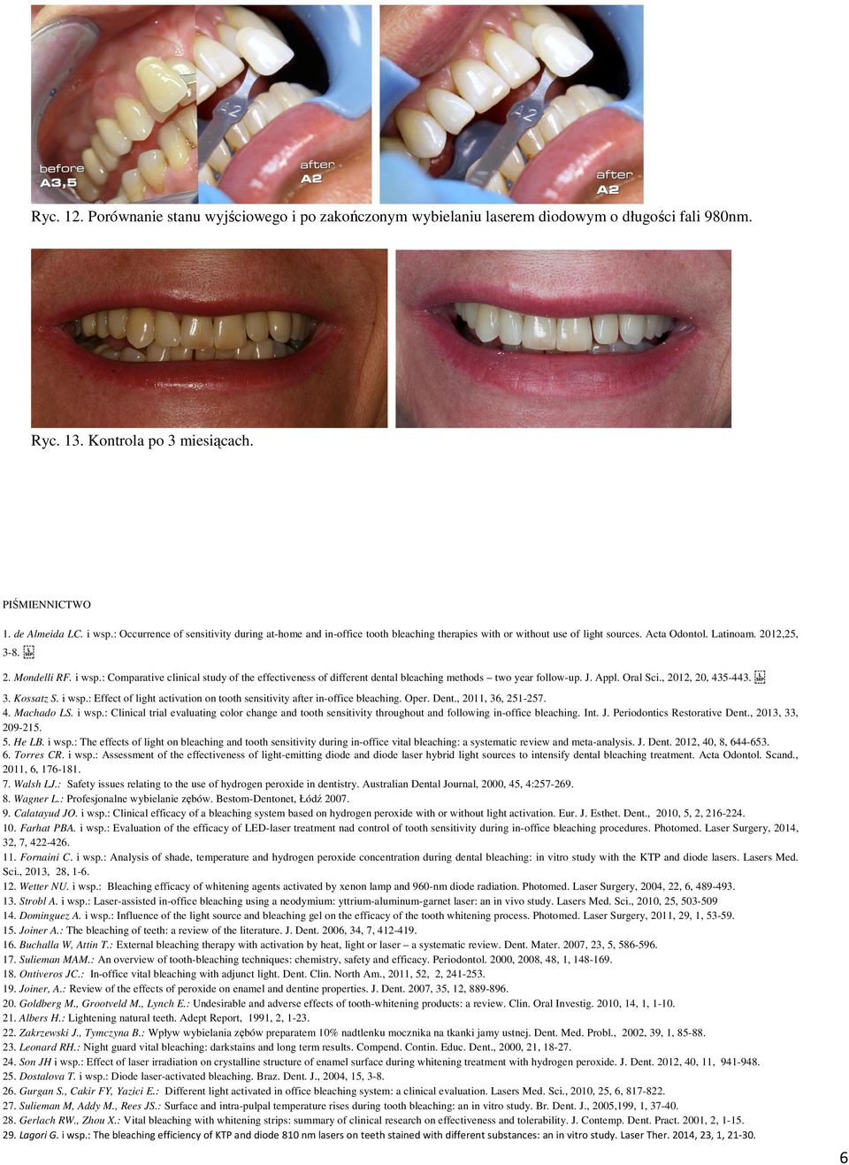 : Comparative clinical study of the effectiveness of different dental bleaching methods two year follow-up. J. Appl. Oral Sci., 2012, 20, 435-443. 3. Kossatz S. i wsp.