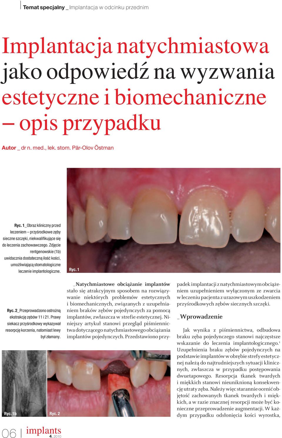 Zdj cie rentgenowskie (1b) uwidacznia dostatecznà iloêç koêci, umo liwiajàcà stomatologiczne leczenie implantologiczne. Ryc. 1 Ryc. 2_Przeprowadzono ostro nà ekstrakcj z bów 11 i 21.