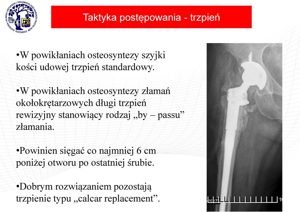 W powikłaniach osteosyntezy złamań okołokrętarzowych długi trzpień rewizyjny