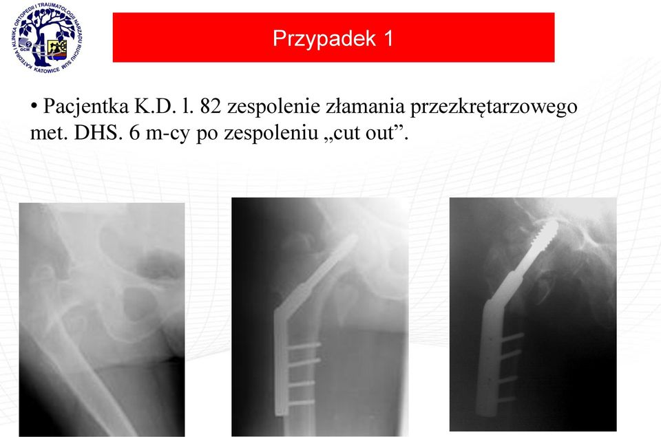 przezkrętarzowego met. DHS.