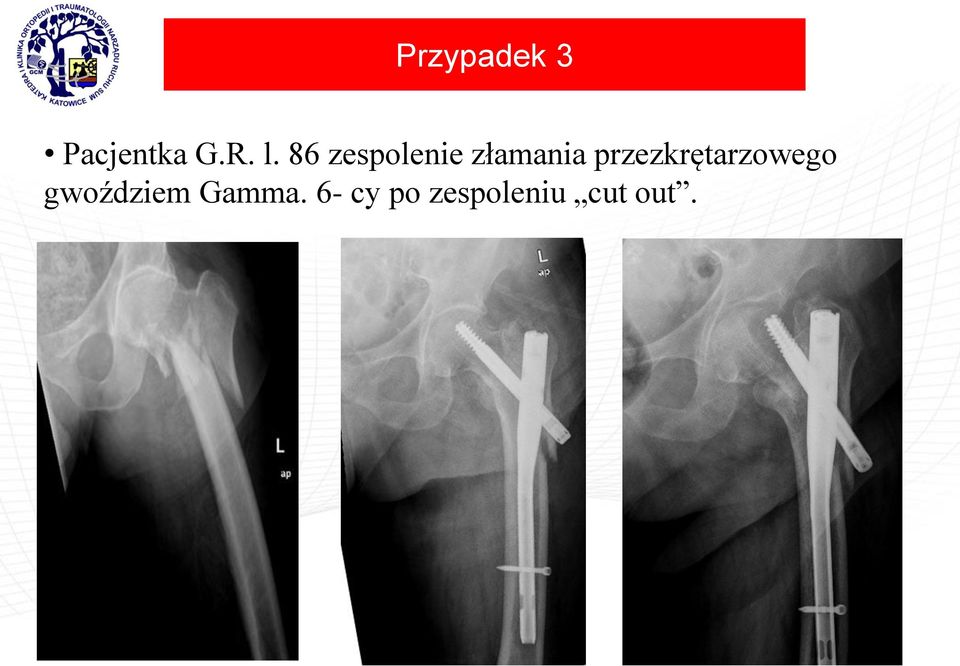 przezkrętarzowego gwoździem