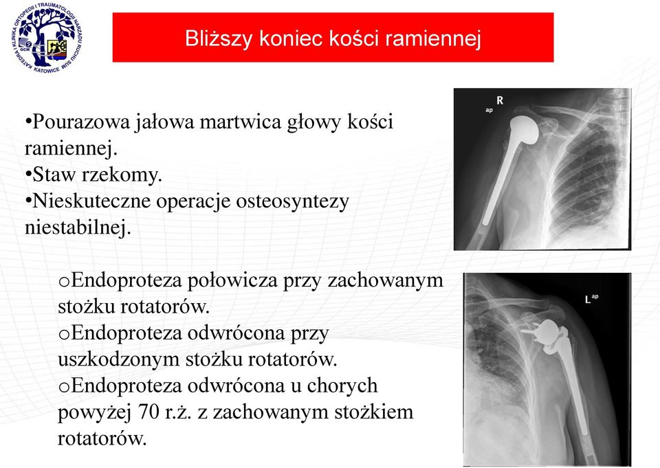 oendoproteza połowicza przy zachowanym stożku rotatorów.